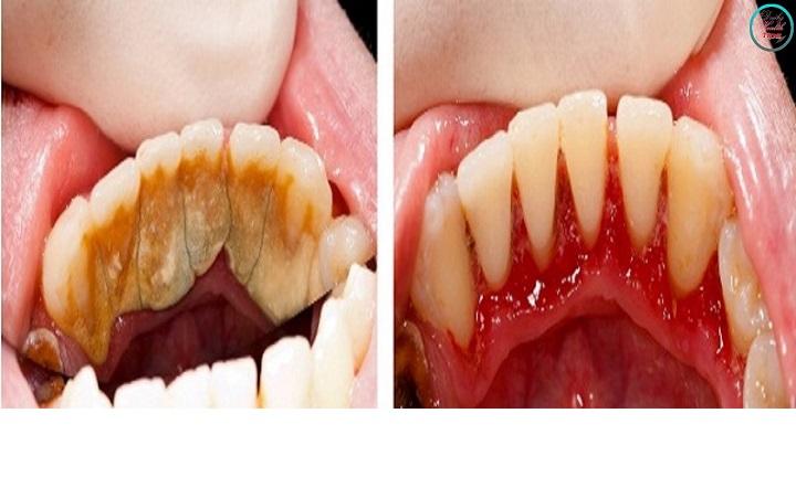 Here's how to get rid of tartar without the help of dentist