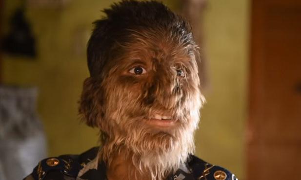 Lalit (13) suffers from rare syndrome, resembles werewolf