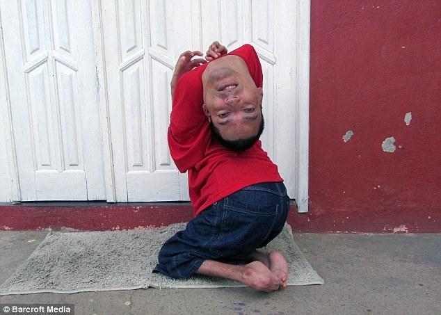 Man born upside down become a model [Video]