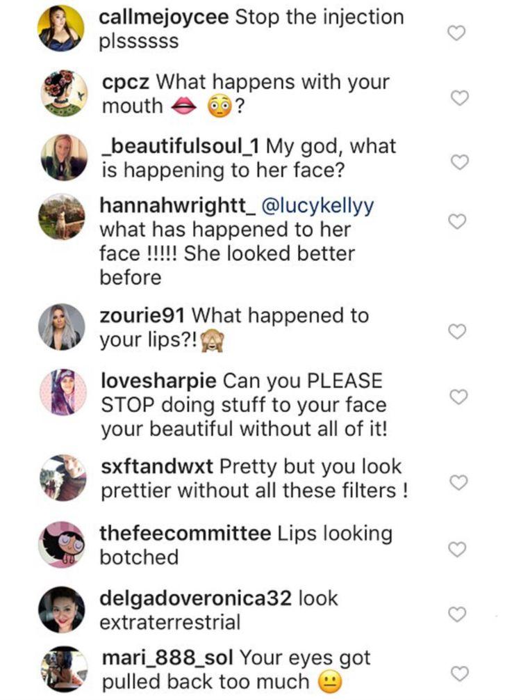 Fans beg Khloe to stop lip injections: "You look like an alien" 