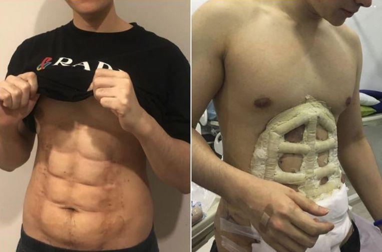 Don't feel like exercising? Thai clinic introduces instant six-pack 