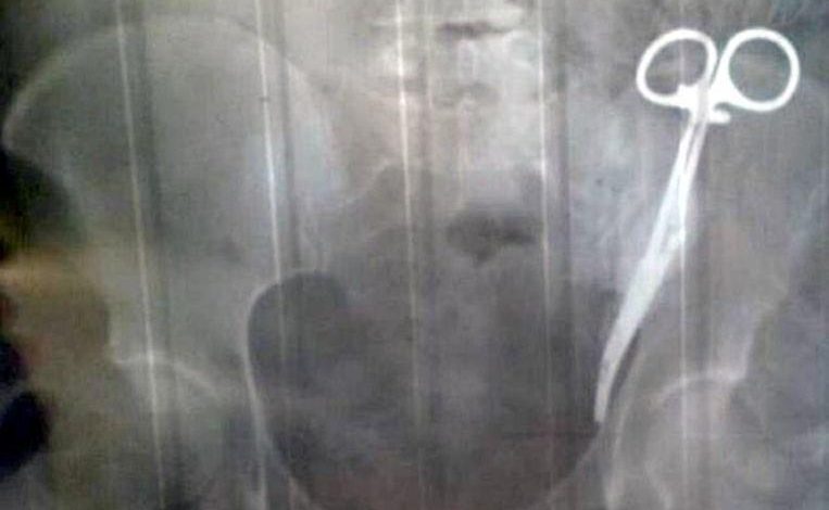 Russian woman walks around for 23 years with surgical clamp in her stomach