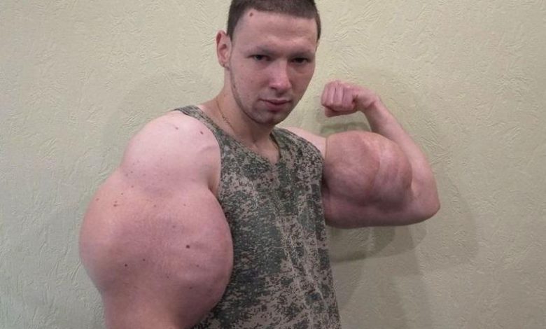 Popeye bodybuilder wants to get rid of oil-filled mega biceps