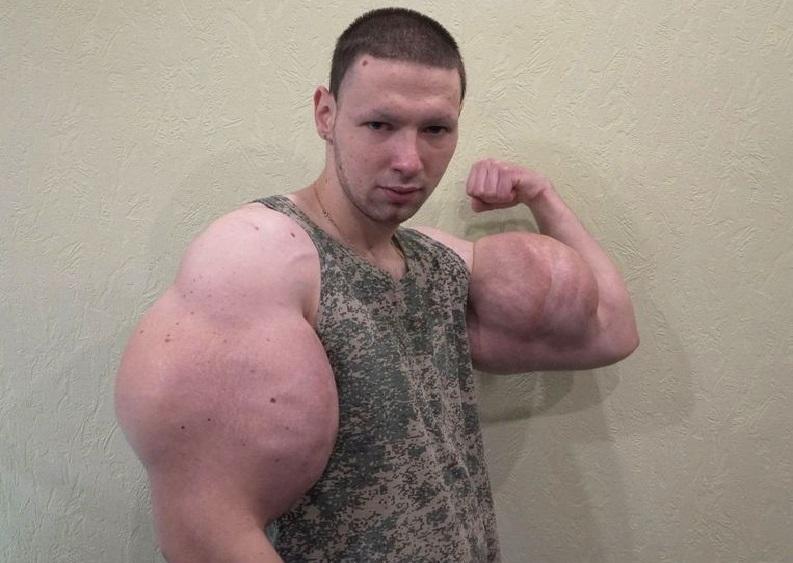 Popeye bodybuilder wants to get rid of oil-filled mega biceps