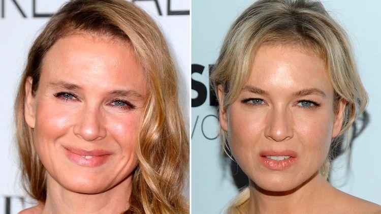 consequences of surgeries on Renée Zellweger's face