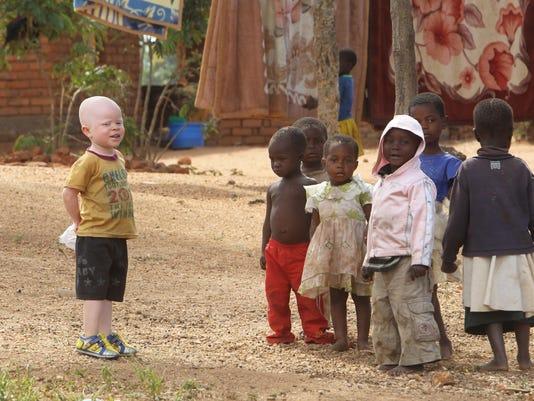 Albino’s victims of ritual crimes in southern Africa