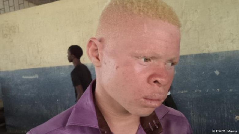Albino’s victims of ritual crimes in southern Africa