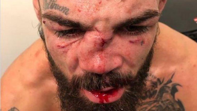Bizarre nose fracture for MMA fighter after brutal duel in cage