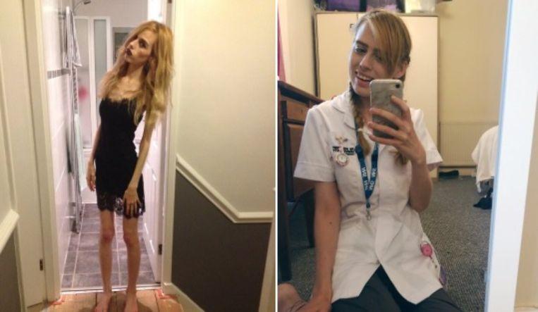 Rebecca shows how she overcame anorexia and receives praises