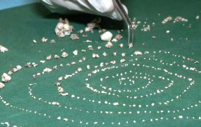 Dental surgeon removes 526 teeth from lump in 7-year-old boy's mouth