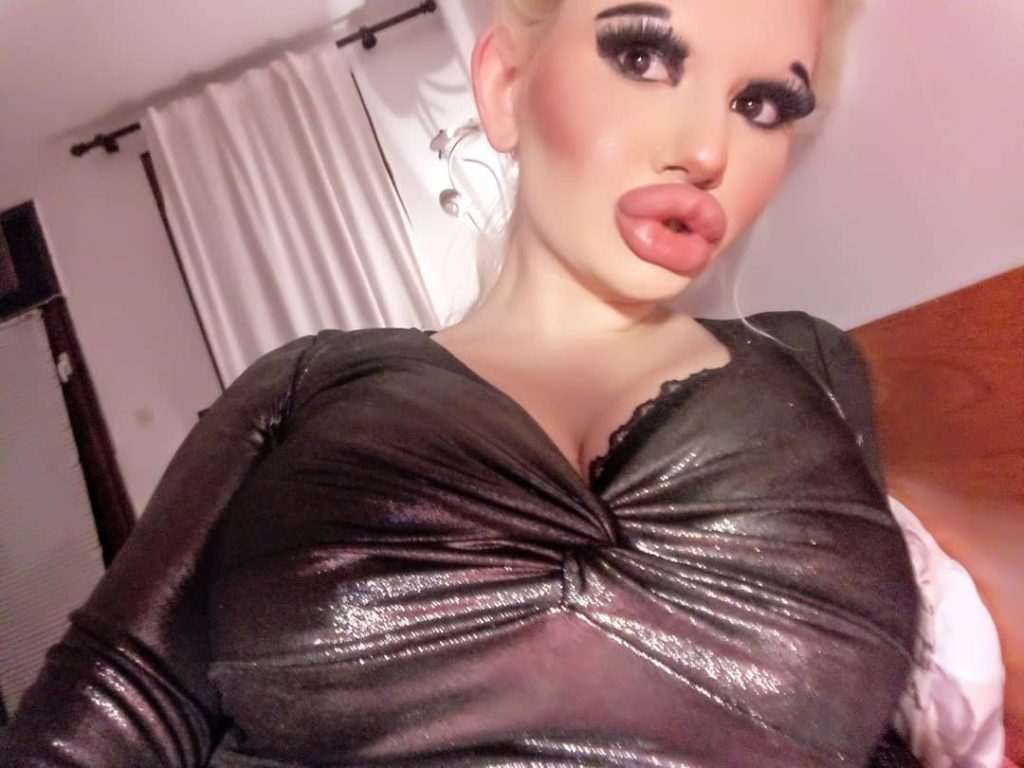 Andrea (22): “No idea if my lips can tolerate more fillers, I don’t draw any boundaries”