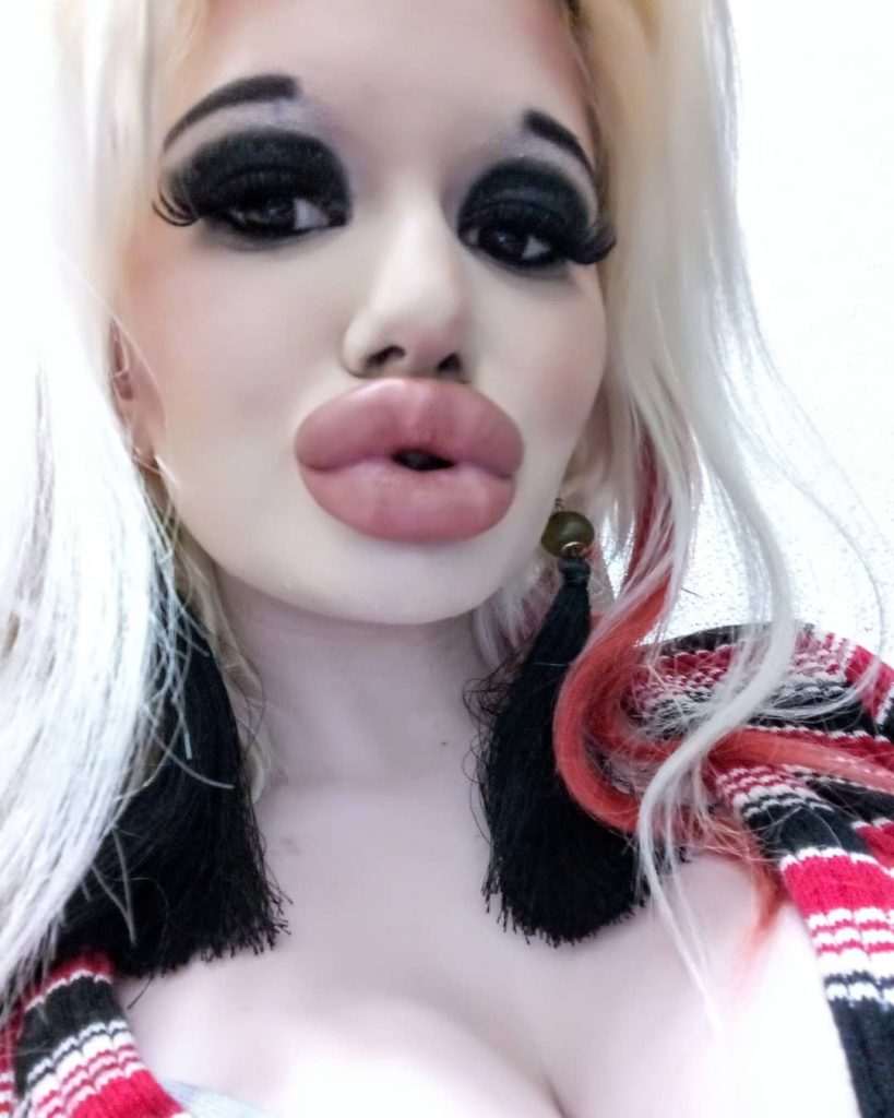 Andrea (22): “No idea if my lips can tolerate more fillers, I don’t draw any boundaries”