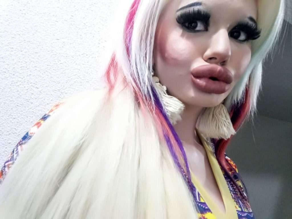 Andrea (22): “No idea if my lips can tolerate more fillers, I don’t draw any boundaries”