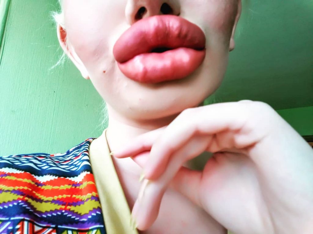 Andrea (22): “No idea if my lips can tolerate more fillers, I don’t draw any boundaries”