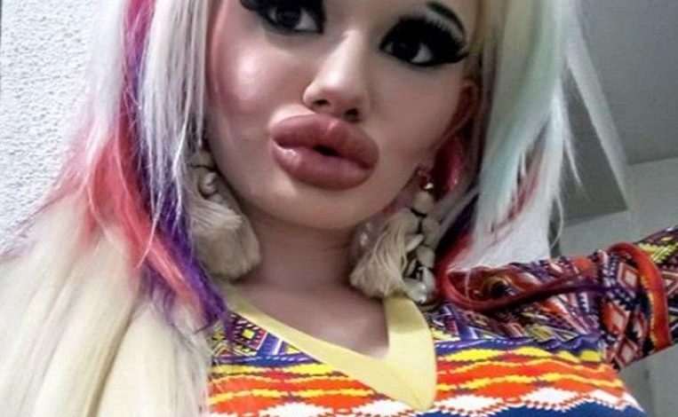 Andrea (22): “No idea if my lips can tolerate more fillers, I don’t draw any boundaries”