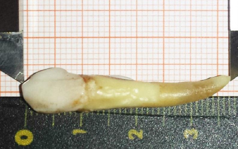 German dentist pulled the longest human tooth in the world: “It was great”