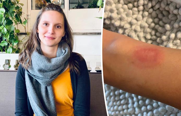Ellen (25) sustains severe burns from Fitbit: “I woke up and felt my arm burn”