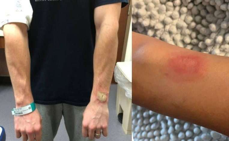Big burns due to Fitbit: is wearing a sports watch dangerous?