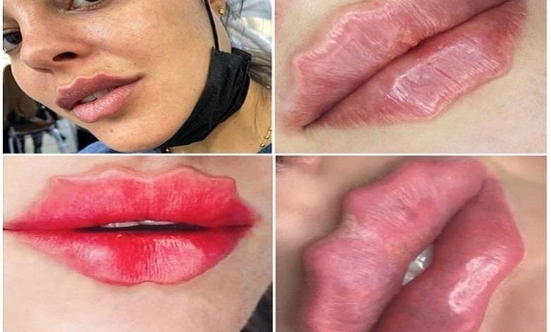 Can it get any crazier? Octopus lips conquer Instagram