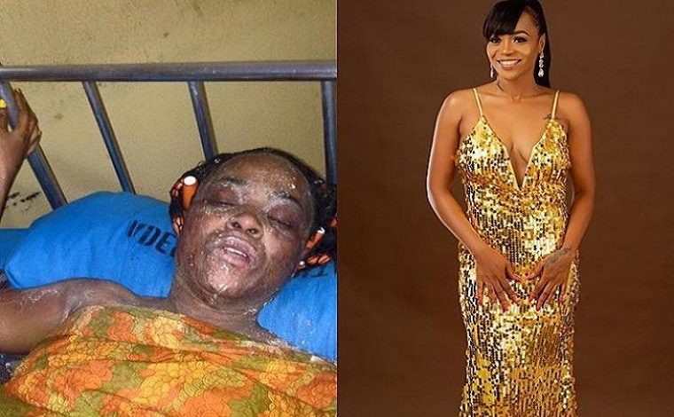 From burn to beauty: Amazing change of gas explosion victimFrom burn to beauty: Amazing change of gas explosion victim