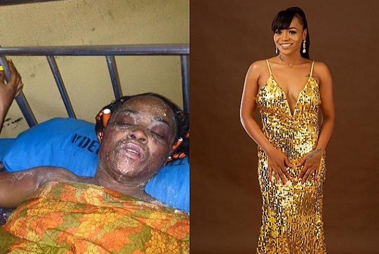 From burn to beauty: Amazing change of gas explosion victimFrom burn to beauty: Amazing change of gas explosion victim