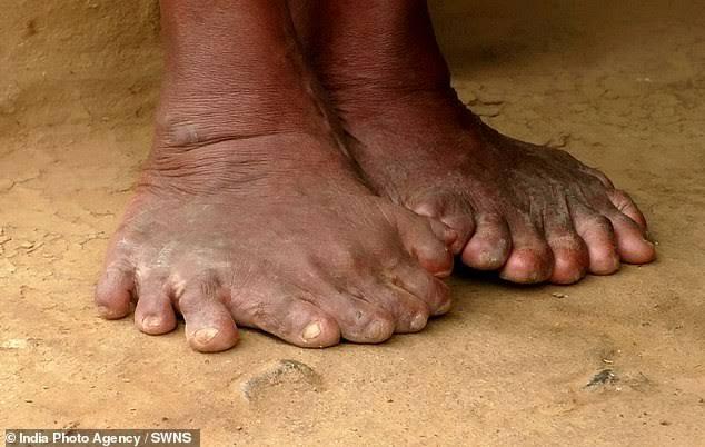 The woman with 31 fingers and toes in India [Photos]