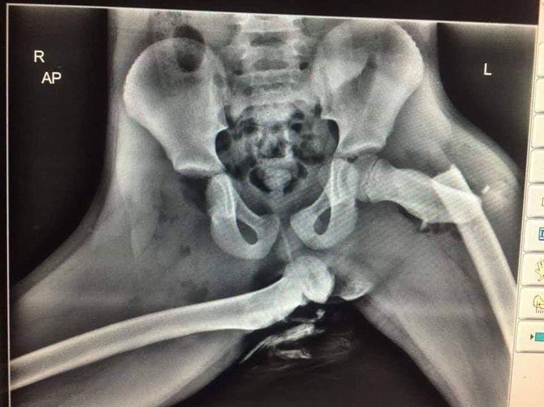 This X-ray of a young woman's pelvis shows the possible consequences for legs and hips when an airbag explodes if you have placed your legs on the dashboard.