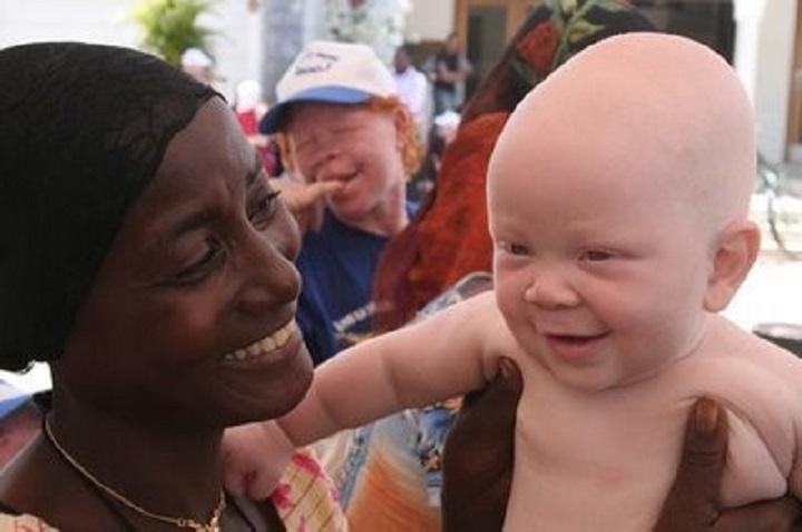 10 wicked misconceptions towards Albino people in Africa