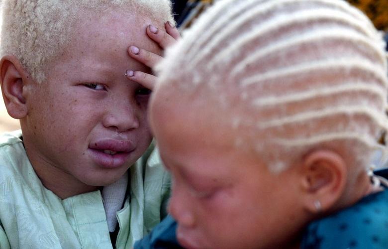 Albino twins beg for money at a mosque in Senegal