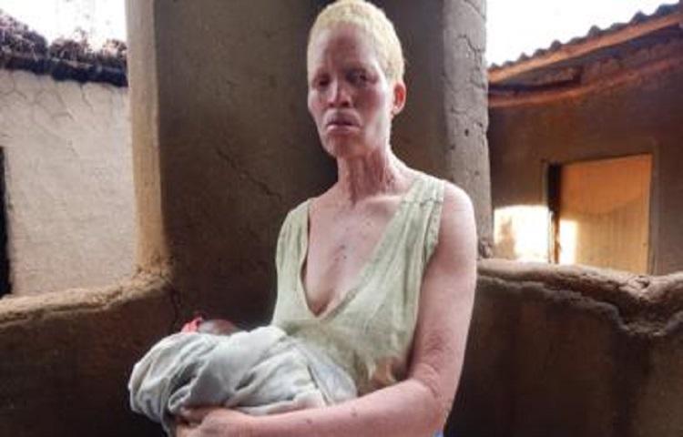 10 wicked misconceptions towards Albino people in Africa
