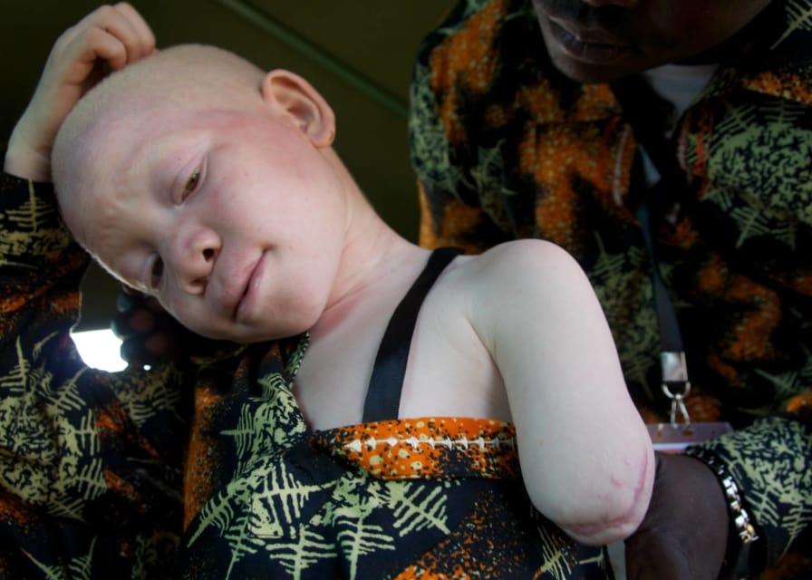 a young albino girl's was chopped off