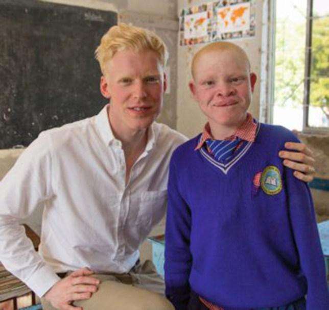 10 wicked misconceptions towards Albino people in Africa