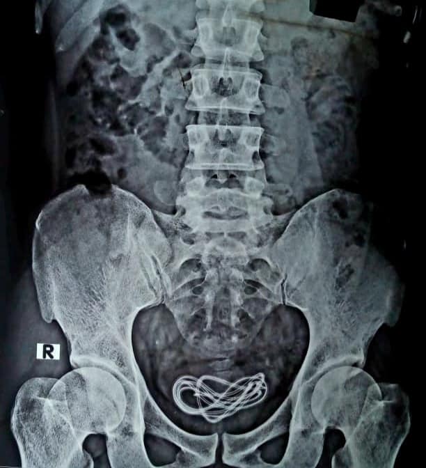 USB Cable removed from man’s urinary bladder