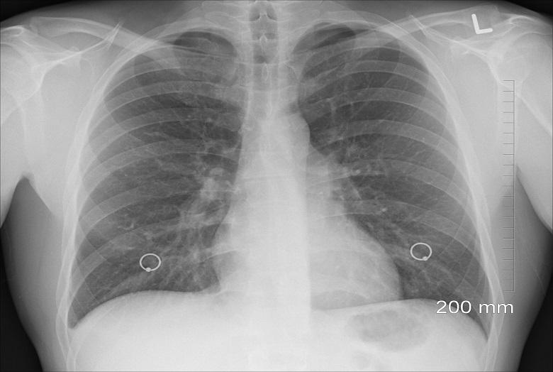Doctors remove swallowed coin from patient’s lung