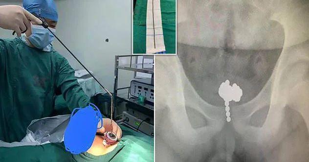 Magnets found in man’s private organ, USB cord remove from bladder
