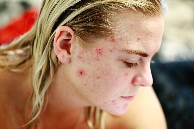 Reason 1 in 2 teenagers hide their acne on social media