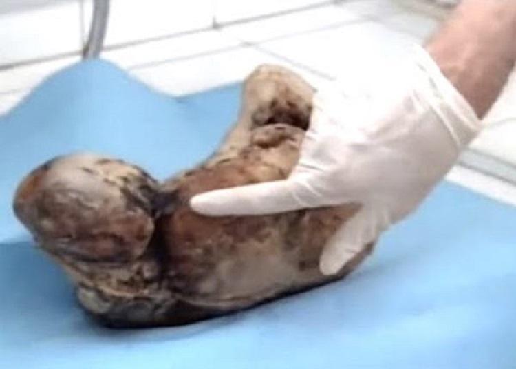 Zahra Aboutalib 70-years-old  woman who gave birth to a stone baby 