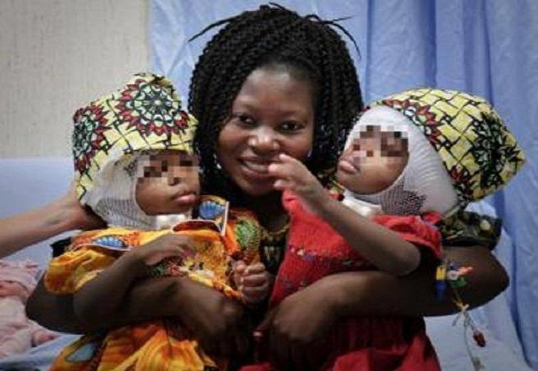 Doctors in Vatican hospital separate Siamese twins from Central African Republic