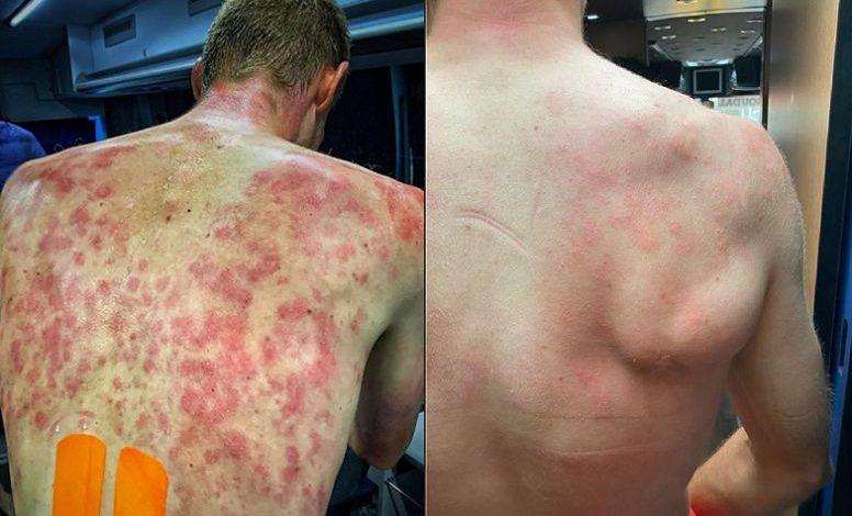 Riders in Dauphiné get heavy hail showers and battered back