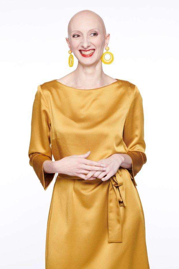 Top 5 women who have Alopecia and embraced their baldness