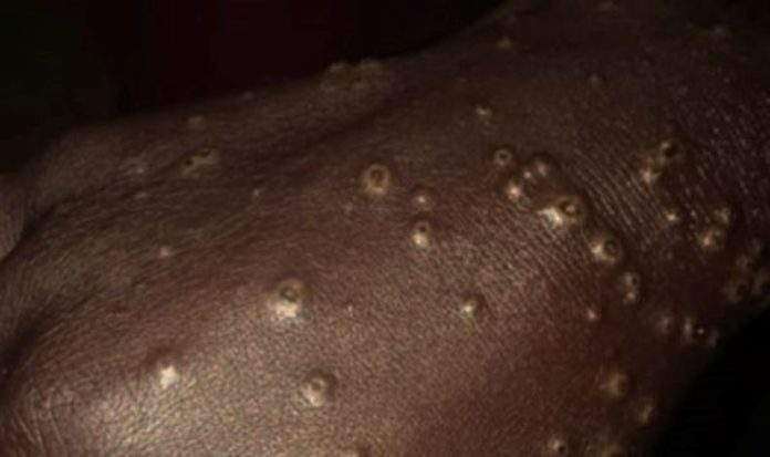 In Senegal, a mysterious disease is raising dust in Dakar 