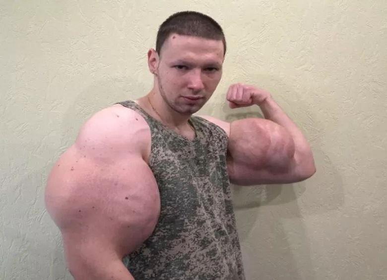 Man injected oil into his biceps, he fears losing arms
