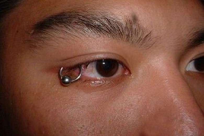 Eyelid piercing