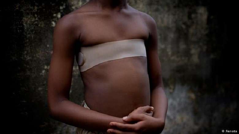 Breast ironing