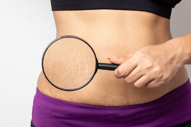 What causes stretch marks? Myths and truths