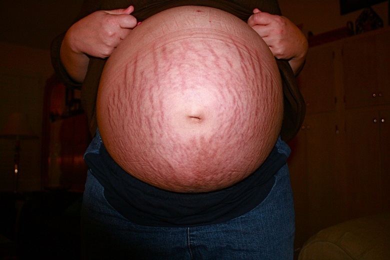 What causes stretch marks? Myths and truths