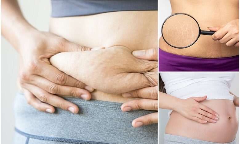 What causes stretch marks? Myths and truths
