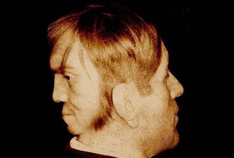 The assumed mummified skull of Edward Mordrake. The image shows a papier-mâché sculpture by the artist Ewart Schindler.