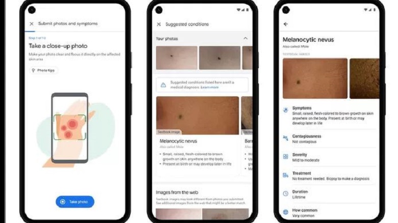 This new Google feature helps detect skin cancer