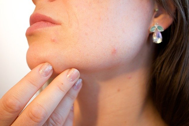 How to get rid of annoying pimples on the back